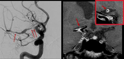 Imaging Inflammation – From Whole Body Imaging to Cellular Resolution